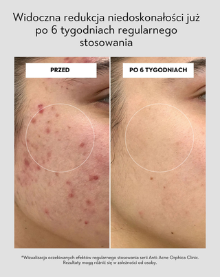 Peeling do twarzy z niacynamidem, pantenolem, BHA i mikrogranulkami Anti-Acne Orphica Clinic 100 ml - 5