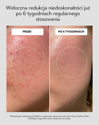 Serum na noc wspierające regenerację skóry problematycznej Anti-Acne Orphica Clinic 50 ml - 6