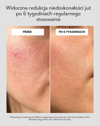 Krem na dzień przeciwtrądzikowy z kwasem salicylowym i azelainowym Anti-Acne Orphica Clinic 50 ml - 5