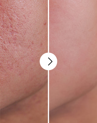 Tabletki na trądzik, pryszcze i niedoskonałości z cynkiem, witaminą C, E i B2 Derminax_4 - 4