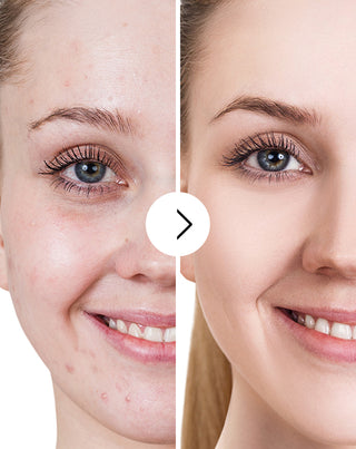 Tabletki na trądzik, pryszcze i niedoskonałości z cynkiem, witaminą C, E i B2 Derminax_5 - 5