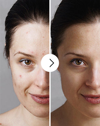 Tabletki na trądzik, pryszcze i niedoskonałości z cynkiem, witaminą C, E  i B2 Derminax_3 - 3