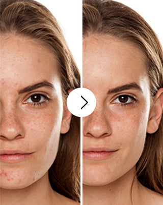 Tabletki na trądzik, pryszcze i niedoskonałości z cynkiem, witaminą C, E  i B2 Derminax_2 - 2