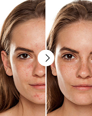 Tabletki na trądzik, pryszcze i niedoskonałości z cynkiem, witaminą C, E  i B2 Derminax_2 - 2