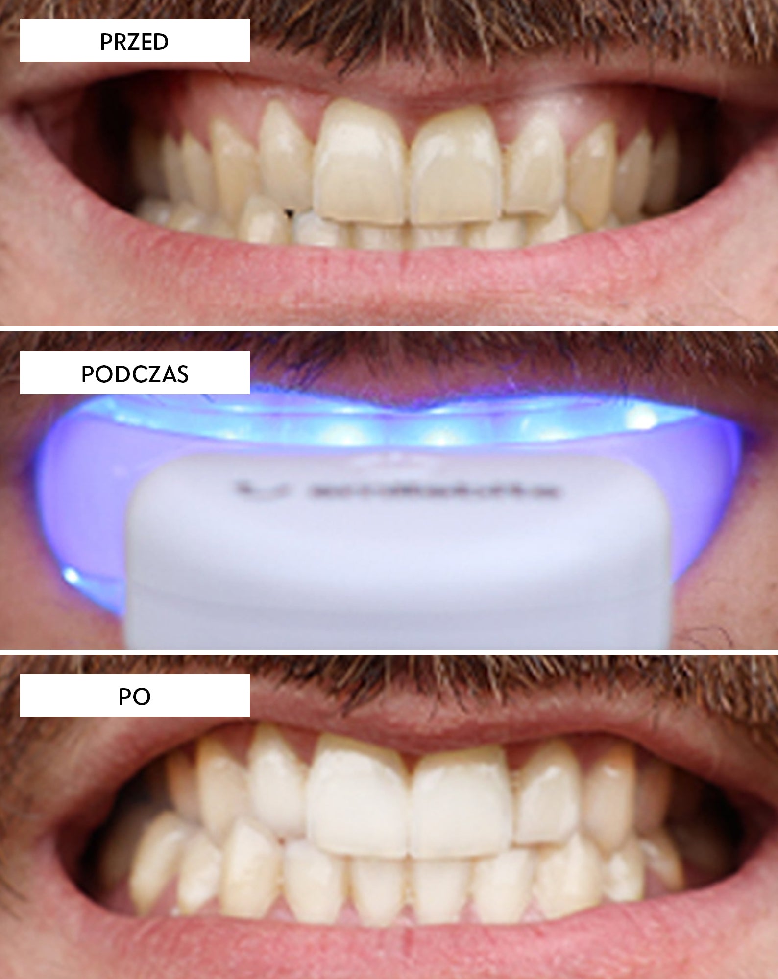 Zestaw do wybielania zębów z lampą LED i żelem wybielającym Light &amp; Bright Smilebite