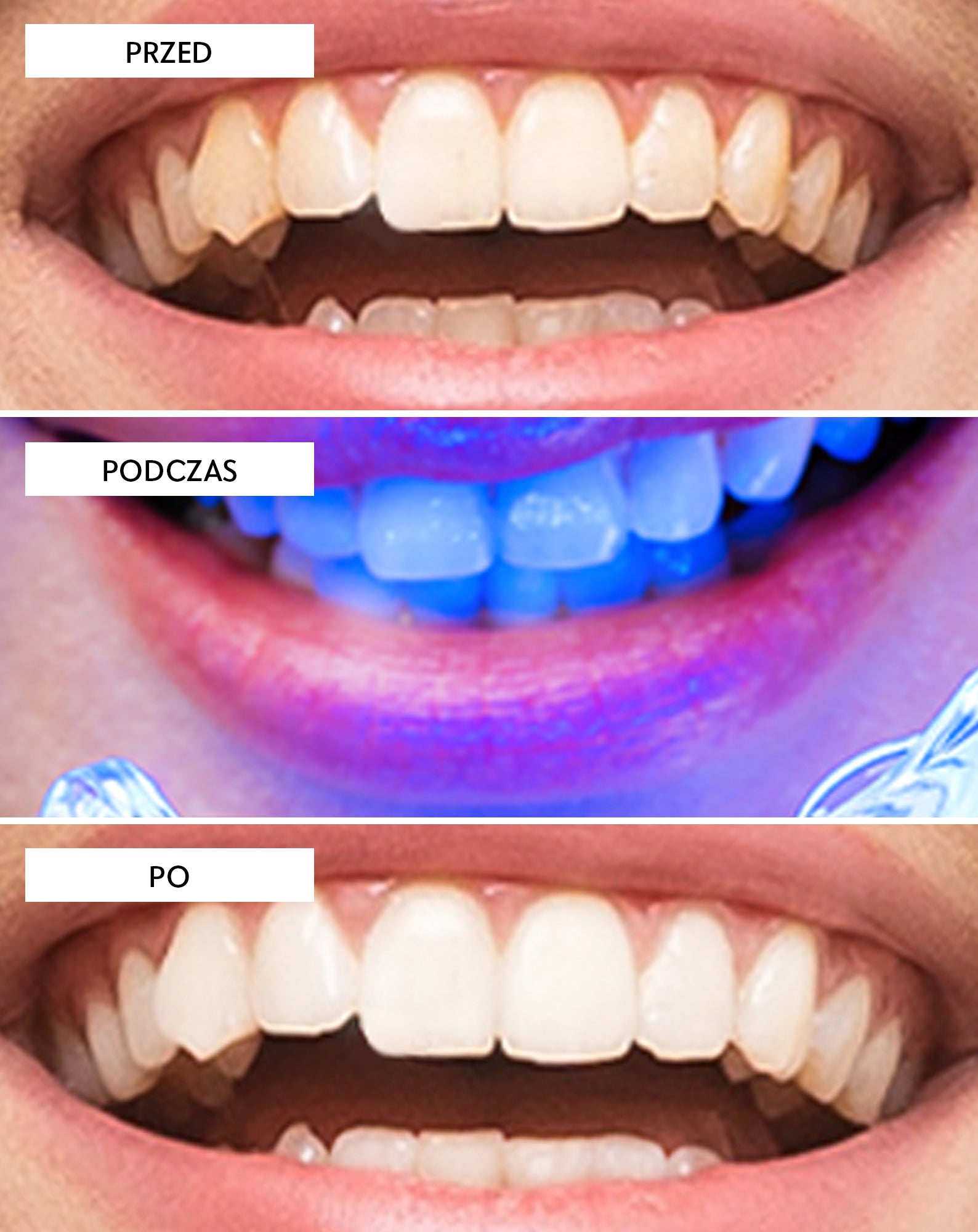 Zestaw do wybielania zębów z lampą LED i żelem wybielającym Light &amp; Bright Smilebite