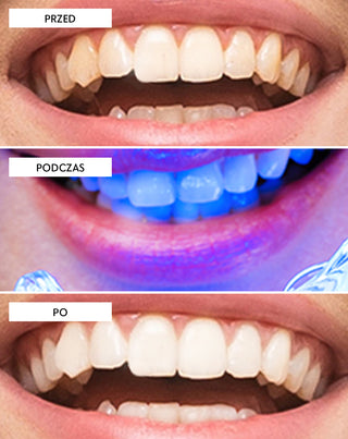 Zestaw do wybielania zębów z lampą LED i żelem wybielającym Light &amp; Bright Smilebite