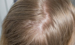 Użytkownicy - Serum do włosów i skóry głowy dla kobiet Fortesse Halier